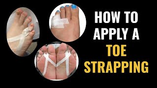 What To Do For A Broken Pinky Toe How To Tape amp Little Toe Treatment [upl. by Jann26]