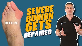 Bunion Surgery Video Saw Bones Dr Blitz [upl. by Naginnarb]