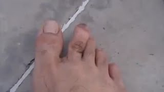 Dislocated Toe Popped Back In  MAJER Jacob [upl. by Anazus]