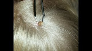 Removing a tick from my childs head [upl. by Bonne]