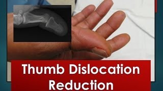 Thumb Dislocation Reduction [upl. by Nedry]