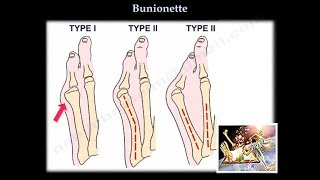 Bunionette  Everything You Need To Know  Dr Nabil Ebraheim [upl. by Floro]