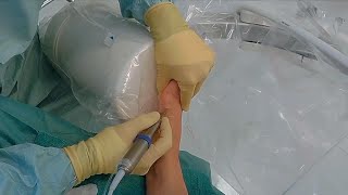 New Less Invasive Bunion Surgery [upl. by Ettennaej]