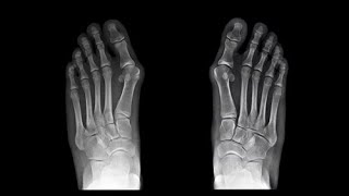 Bunion Surgery An Overview [upl. by Kimon]