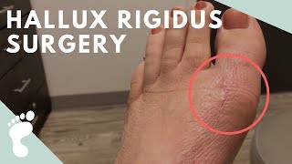 Hallux Rigidus Surgery [upl. by Azmah]