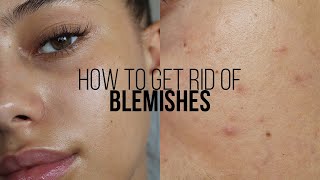 HOW TO GET RID OF BLEMISHES IN 3 DAYS  Jessicvpimentel [upl. by Anselmo]