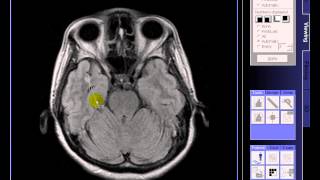 BRAIN MRI Multiple lacunar infarcts [upl. by Assyn]