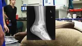 Ankle Fracture Dislocation Reduction [upl. by Eulau]