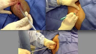 Chest Tube Placement [upl. by Une]