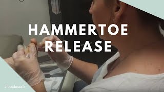 Hammertoe Tendon Release [upl. by Nielsen109]